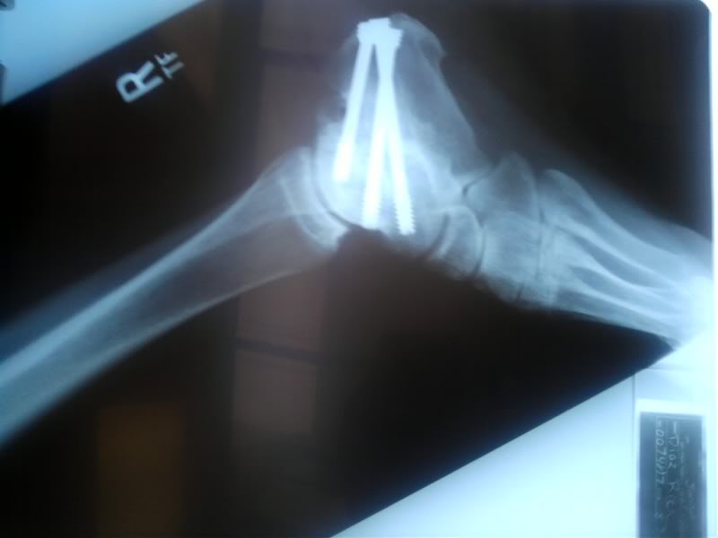 Name:  Anklesurgery3-1.jpg
Views: 32
Size:  39.6 KB